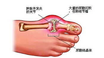 足痛风的发病示意图.