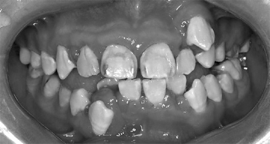 你知道青春期龈炎吗?